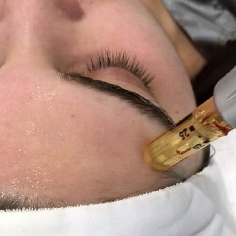 Microneedeling Facial